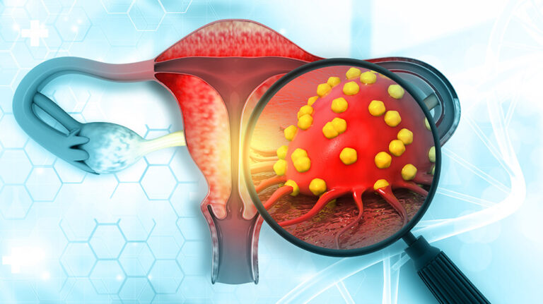 Cáncer de cuello uterino es la segunda causa de muerte en mujeres venezolanas