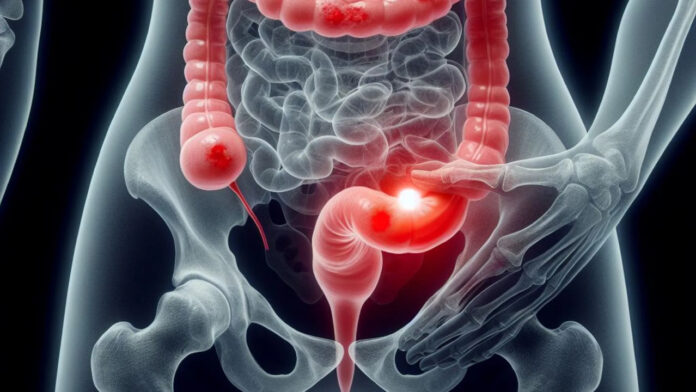 Tratan primer paciente en Inglaterra con una vacuna contra el cáncer de colon