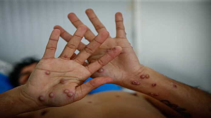 Brasil investiga un posible caso de viruela del mono en un pasajero que llegó a São Paulo