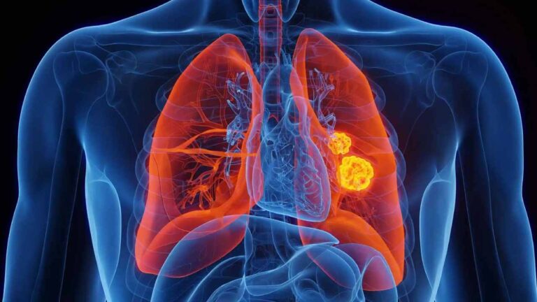 Más de 5 mil 800 personas podrían ser diagnosticadas con cáncer de pulmón en Venezuela este 2024