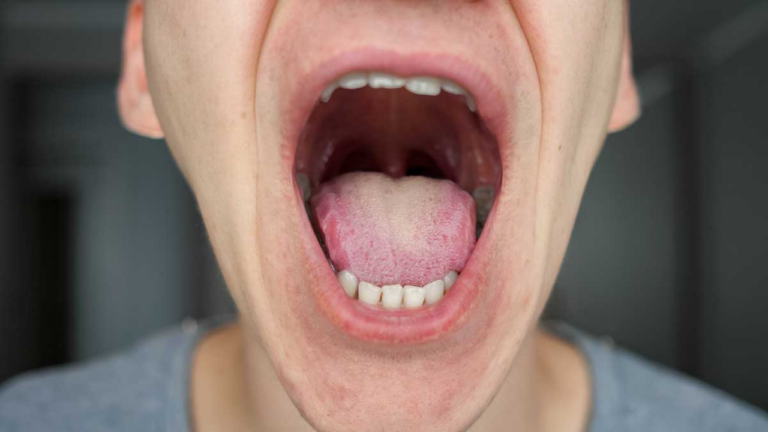 Expertos recomiendan prestar atención a la boca para evitar el cáncer bucal