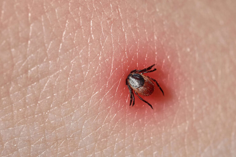 ¿Qué es el virus de la garrapata y cómo se transmite?