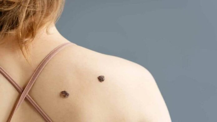melanoma-caracteristicas